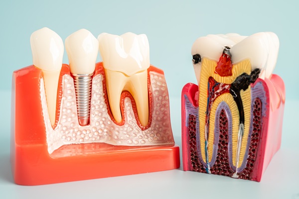 What Is Root Canal Surgery (Apicoectomy)?