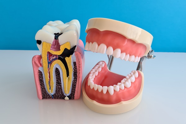 When Root Canal Surgery May Be Recommended To Save Your Tooth